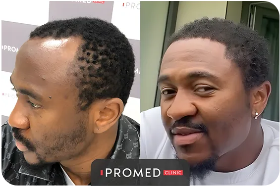 Before After 48