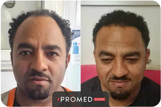 Before After 49