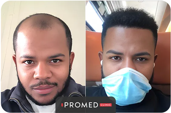 Before After 50