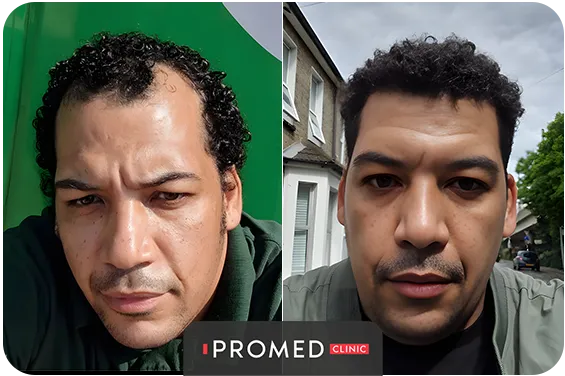 Before After 51