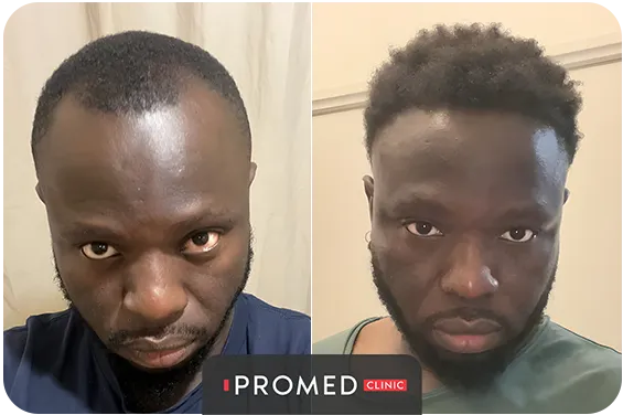 Before After 52