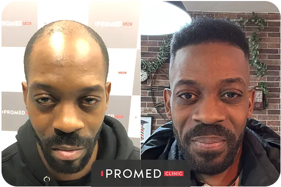 Before After 53
