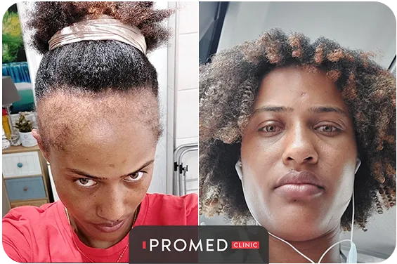 Before After 54
