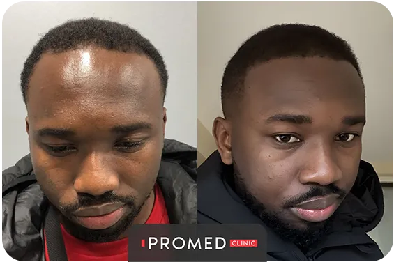 Before After 55