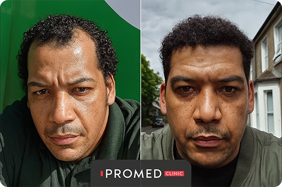 Before After 12