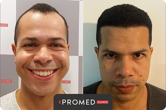 Before After 2