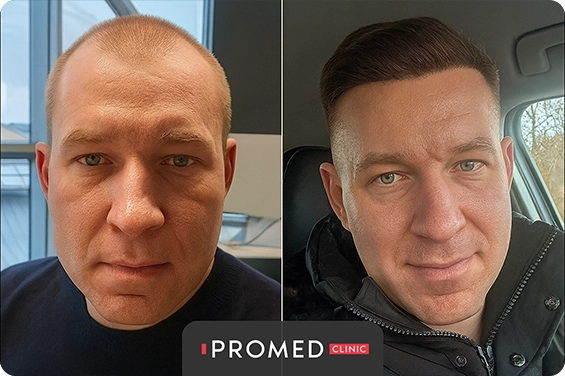 Before After 5