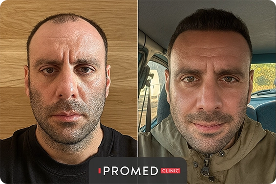 Before After 6