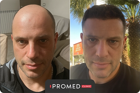 Before After 7