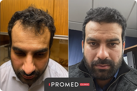Before After 9