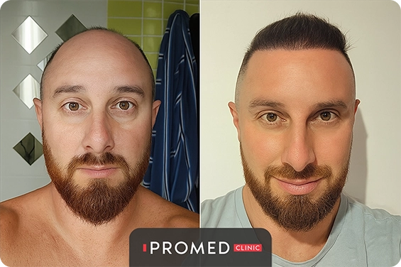 Before After 10