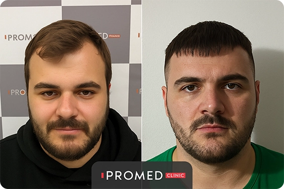 Before After 11