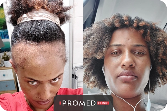 Before After 56