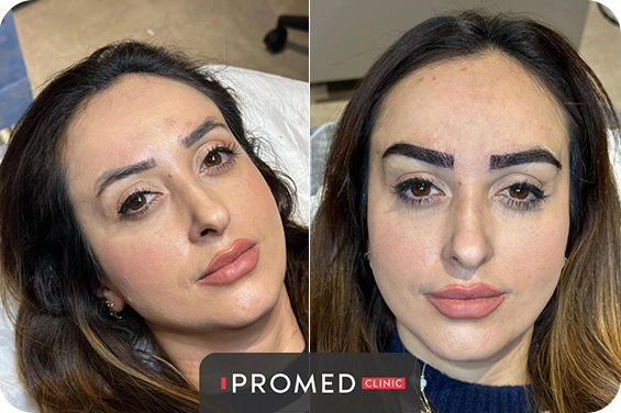 Before After 57