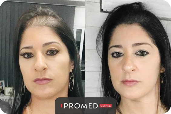 Before After 58