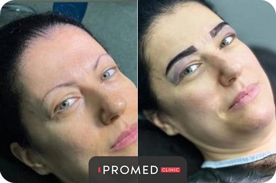 Before After 59