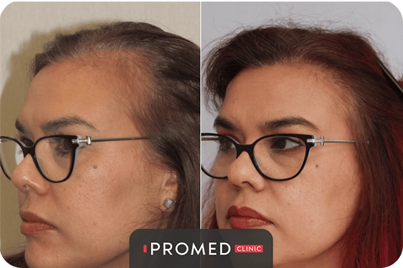 Before After 60