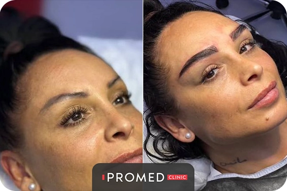 Before After 61